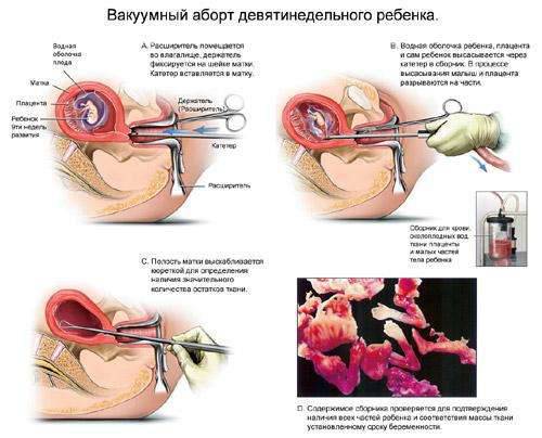 Я беременна как сделать выкидыш Я беременна как сделать выкидыш