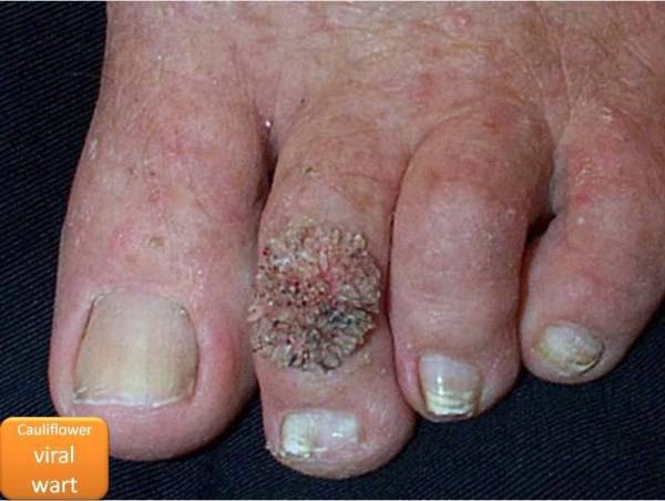 Warts